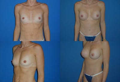 Small C Natural Shape Breast Before & After Gallery - Patient 2387852 - Image 1