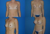 Small C Natural Shape Breast Before & After Gallery - Patient 2387852 - Image 1