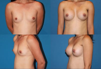 Small C Natural Shape Breast Before & After Gallery - Patient 2387853 - Image 1