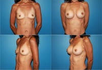 Breast Augmentation Before & After Gallery - Patient 2158602 - Image 1