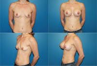 Small C Round Breast Before & After Gallery - Patient 2387924 - Image 1