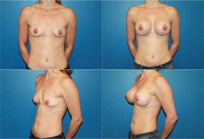 Small C Round Breast Before & After Gallery - Patient 2387924 - Image 1