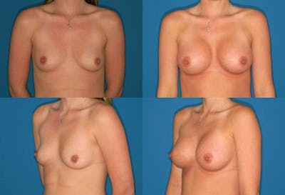 Medium C Natural Shape Breast Before & After Gallery - Patient 2387933 - Image 1