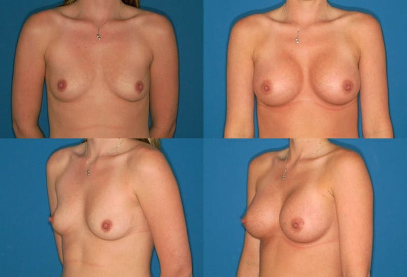 Medium C Natural Shape Breast Before & After Gallery - Patient 2387933 - Image 1