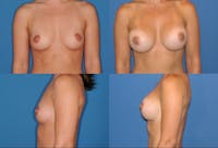 Medium C Natural Shape Breast Before & After Gallery - Patient 2387934 - Image 1