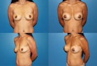 Medium C Natural Shape Breast Before & After Gallery - Patient 2387935 - Image 1