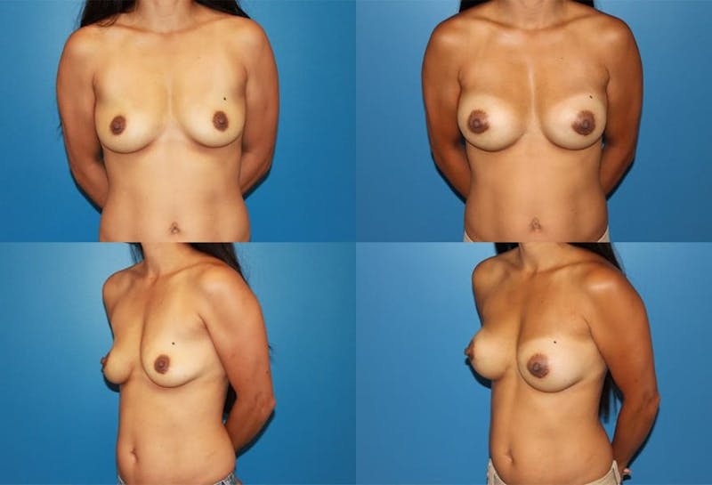 Medium C Natural Shape Breast Before & After Gallery - Patient 2387935 - Image 1