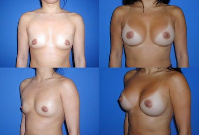 Medium C Natural Shape Breast Before & After Gallery - Patient 2387937 - Image 1