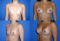 Medium C Natural Shape Breast Before & After Gallery - Patient 2387937 - Image 1