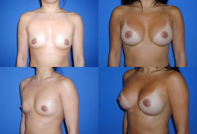 Breast Augmentation Before & After Gallery - Patient 2158612 - Image 1