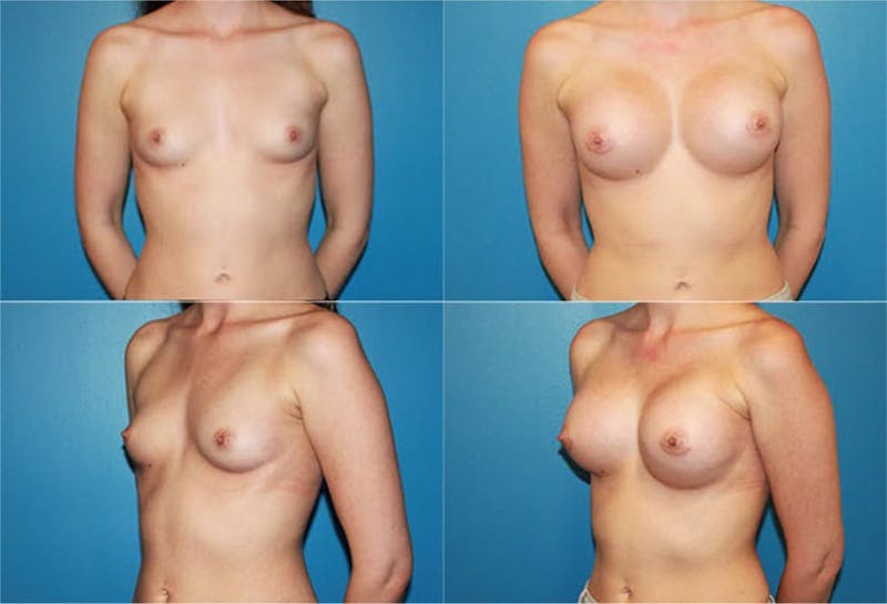 Medium C Round Breast Before & After Gallery - Patient 2387942 - Image 1
