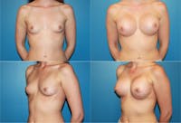 Medium C Round Breast Before & After Gallery - Patient 2387942 - Image 1
