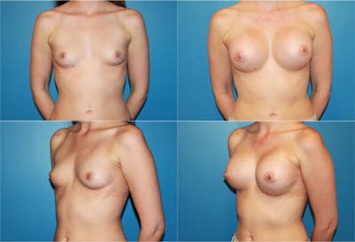 Breast Augmentation Before & After Gallery - Patient 2158613 - Image 1