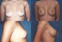 Medium C Round Breast Before & After Gallery - Patient 2387943 - Image 1