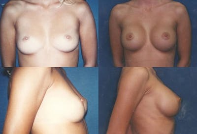 Medium C Round Breast Before & After Gallery - Patient 2387943 - Image 1