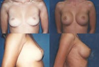 Breast Augmentation Before & After Gallery - Patient 2158614 - Image 1