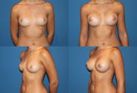 Medium C Round Breast Before & After Gallery - Patient 2387944 - Image 1