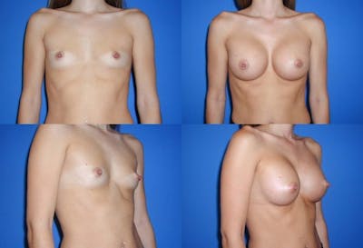Medium C Round Breast Before & After Gallery - Patient 2387945 - Image 1
