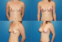 Large C Natural Shaped Breast Before & After Gallery - Patient 2387951 - Image 1