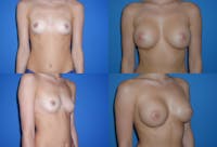 Large C Natural Shaped Breast Gallery - Patient 2387952 - Image 1