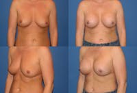 Large C Natural Shaped Breast Before & After Gallery - Patient 2387953 - Image 1