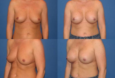 Large C Natural Shaped Breast Before & After Gallery - Patient 2387953 - Image 1