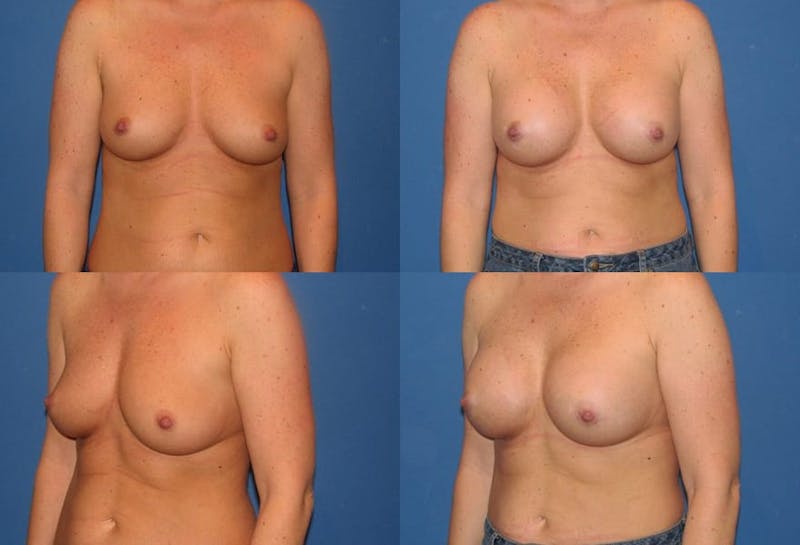 Large C Natural Shaped Breast Before & After Gallery - Patient 2387953 - Image 1