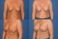 Breast Augmentation Before & After Gallery - Patient 2158625 - Image 1