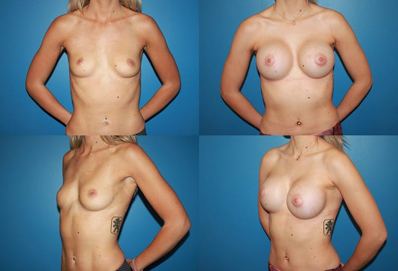 Large C Round Breast Before & After Gallery - Patient 2387997 - Image 1