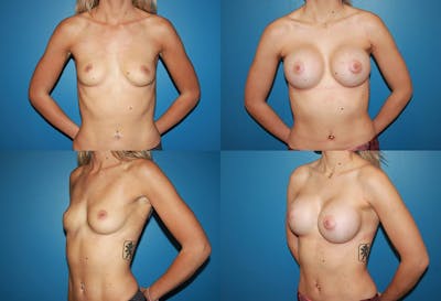 Breast Augmentation Before & After Gallery - Patient 2158626 - Image 1