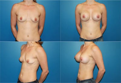 Large C Round Breast Before & After Gallery - Patient 2387998 - Image 1