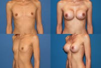 Breast Augmentation Before & After Gallery - Patient 2158628 - Image 1