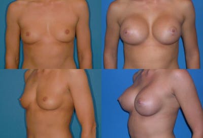 Large C Round Breast Before & After Gallery - Patient 2388001 - Image 1