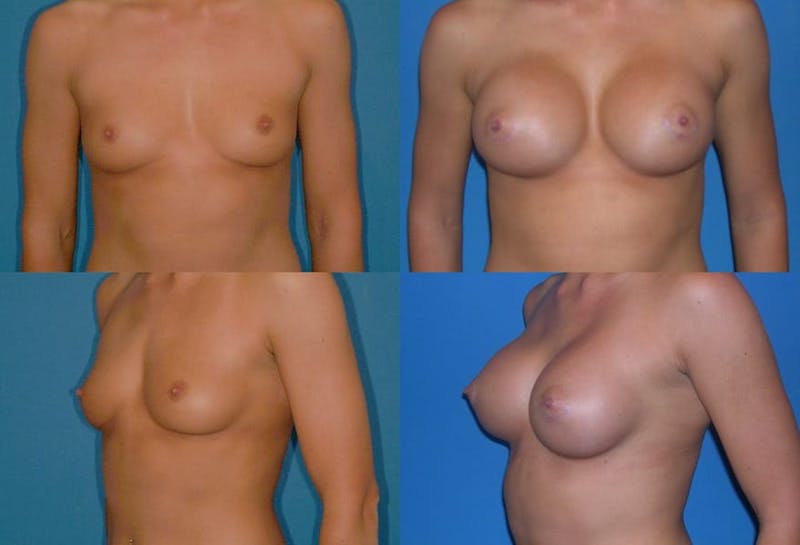 Large C Round Breast Gallery - Patient 2388001 - Image 1