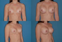 Large C Round Breast Before & After Gallery - Patient 2388002 - Image 1