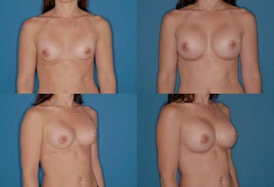 Large C Round Breast Before & After Gallery - Patient 2388002 - Image 1