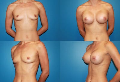 Large C Round Breast Before & After Gallery - Patient 2388003 - Image 1