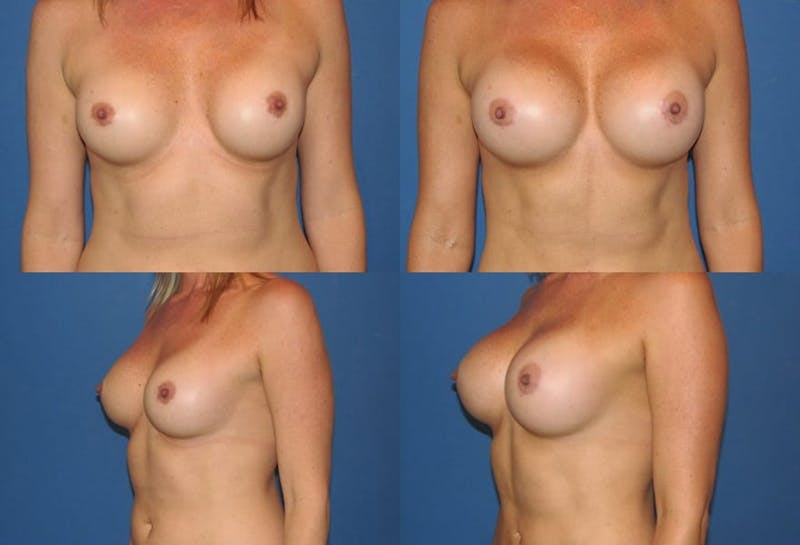 Large C Round Breast Before & After Gallery - Patient 2388004 - Image 1