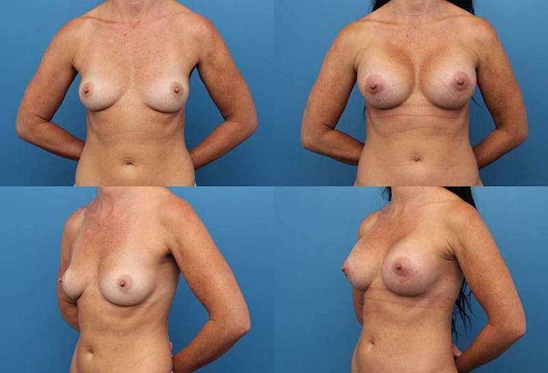 D Cup Breast Before & After Gallery - Patient 2388025 - Image 1
