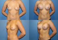 D Cup Breast Before & After Gallery - Patient 2388081 - Image 1