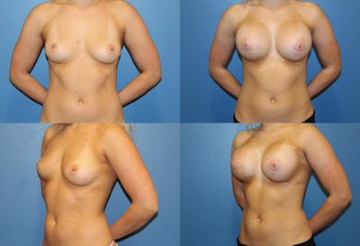 Breast Augmentation Before & After Gallery - Patient 2158637 - Image 1