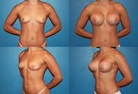 D Cup Breast Before & After Gallery - Patient 2388082 - Image 1