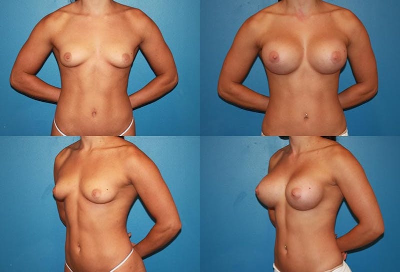 D Cup Breast Before & After Gallery - Patient 2388082 - Image 1