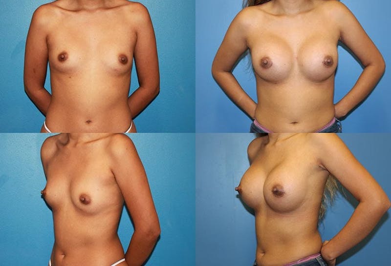 D Cup Breast Before & After Gallery - Patient 2388083 - Image 1
