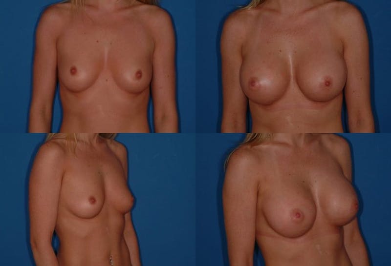 D Cup Breast Before & After Gallery - Patient 2388085 - Image 1