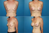 Breast Lift Before & After Gallery - Patient 2158645 - Image 1