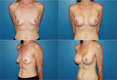 Breast Lift Before & After Gallery - Patient 2158645 - Image 1