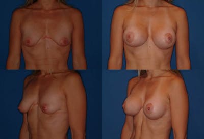 Breast Lift Before & After Gallery - Patient 2158646 - Image 1