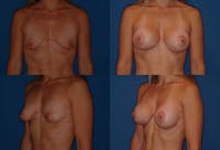 Breast Lift Before & After Gallery - Patient 2158646 - Image 1