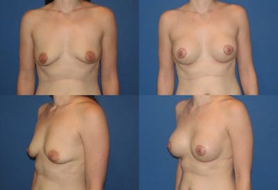 Breast Lift Before & After Gallery - Patient 2158650 - Image 1
